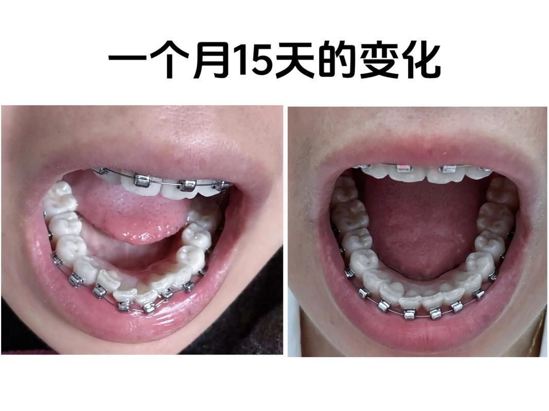 38岁做牙齿矫正晚不晚 过来人告诉你真实经历