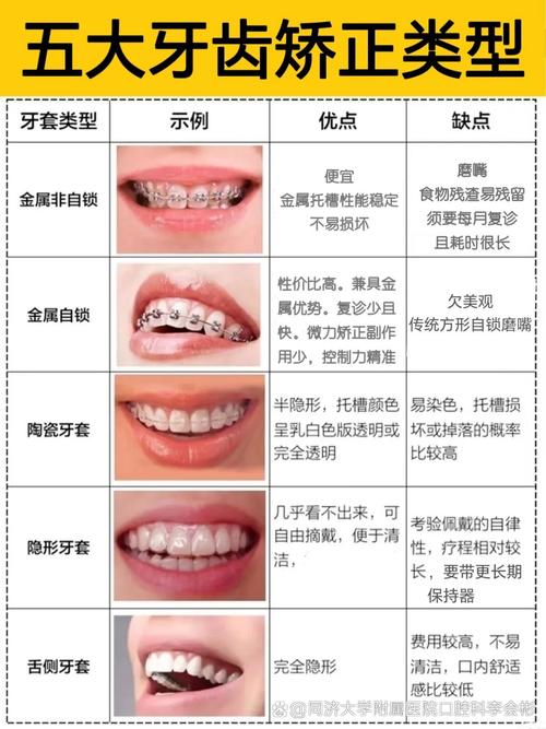 成人畸牙矫正全攻略 别再错过最佳时机