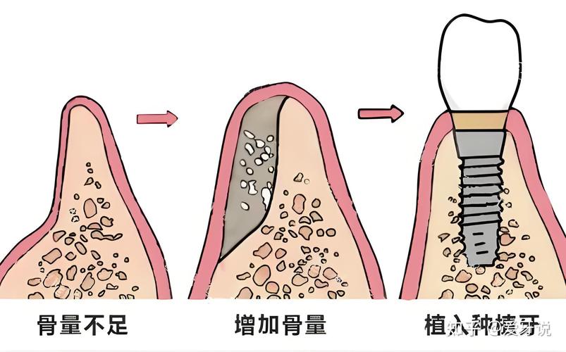 张家口种牙去哪_张家口老年种植牙 骨量不足怎么种_张家口种牙哪家好