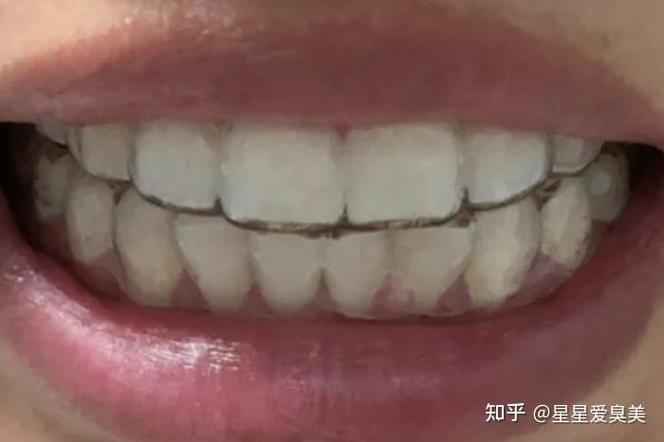 24岁矫正牙齿要花多少钱 这笔钱到底值不值