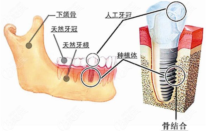 深圳瑞士ITI种植牙 牙槽骨条件要求详解