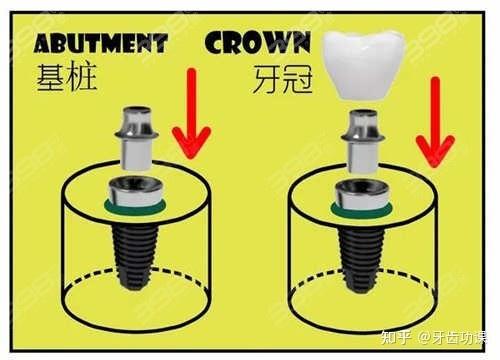 常州种牙正规医院_常州国产种植牙品牌 百康特价格_常州哪家种植牙好又便宜