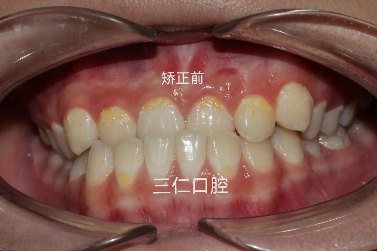 种一颗牙矫正价格是多少 看完这篇心里有数