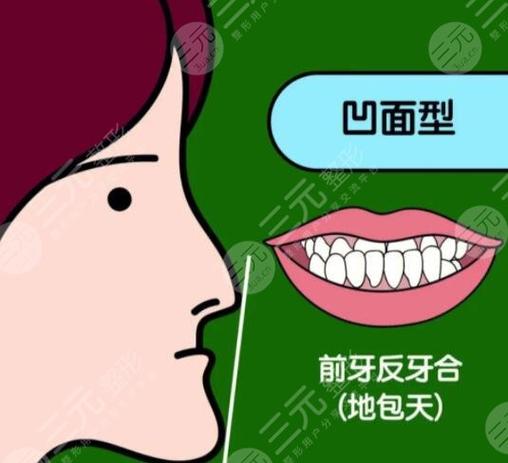 深圳儿童地包天矫正多少钱？2026最新价格表来了