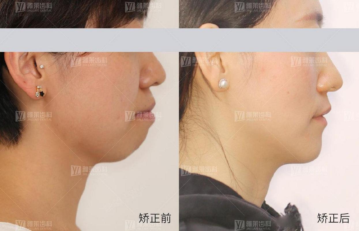 矫正牙齿对脸型的改变到底有多大？真实对比告诉你