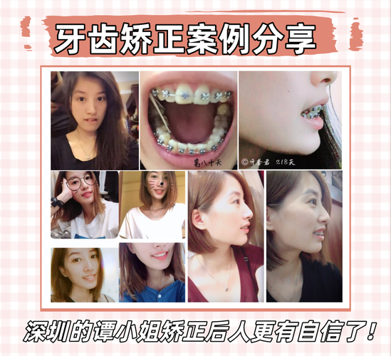 深圳福田成人地包天正畸医院怎么选？看完这篇不踩坑