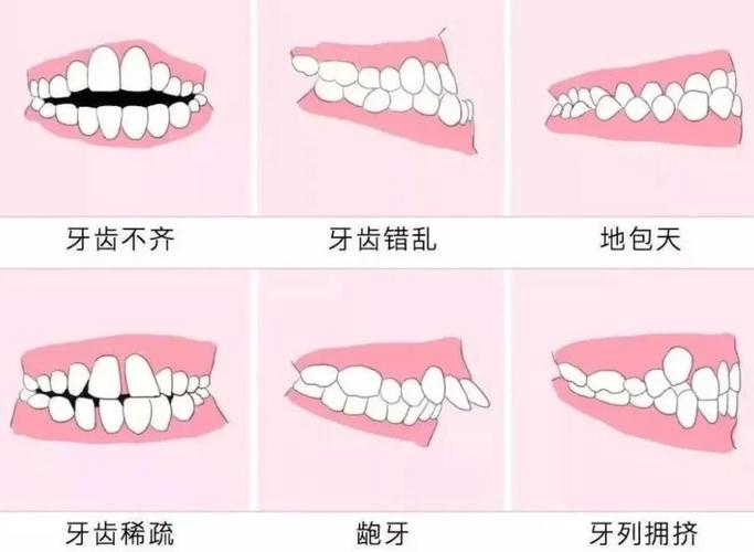 深圳骨性地包天手术医院_深圳福田成人地包天正畸医院_深圳正畸价格
