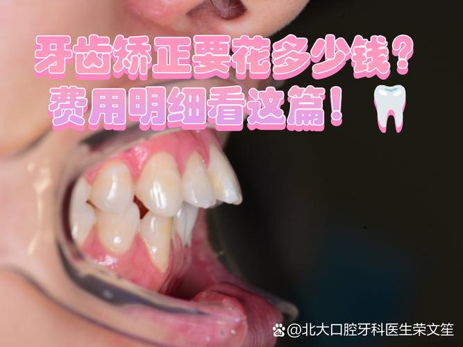 广州牙齿矫正到底要花多少钱？看完这篇不踩坑