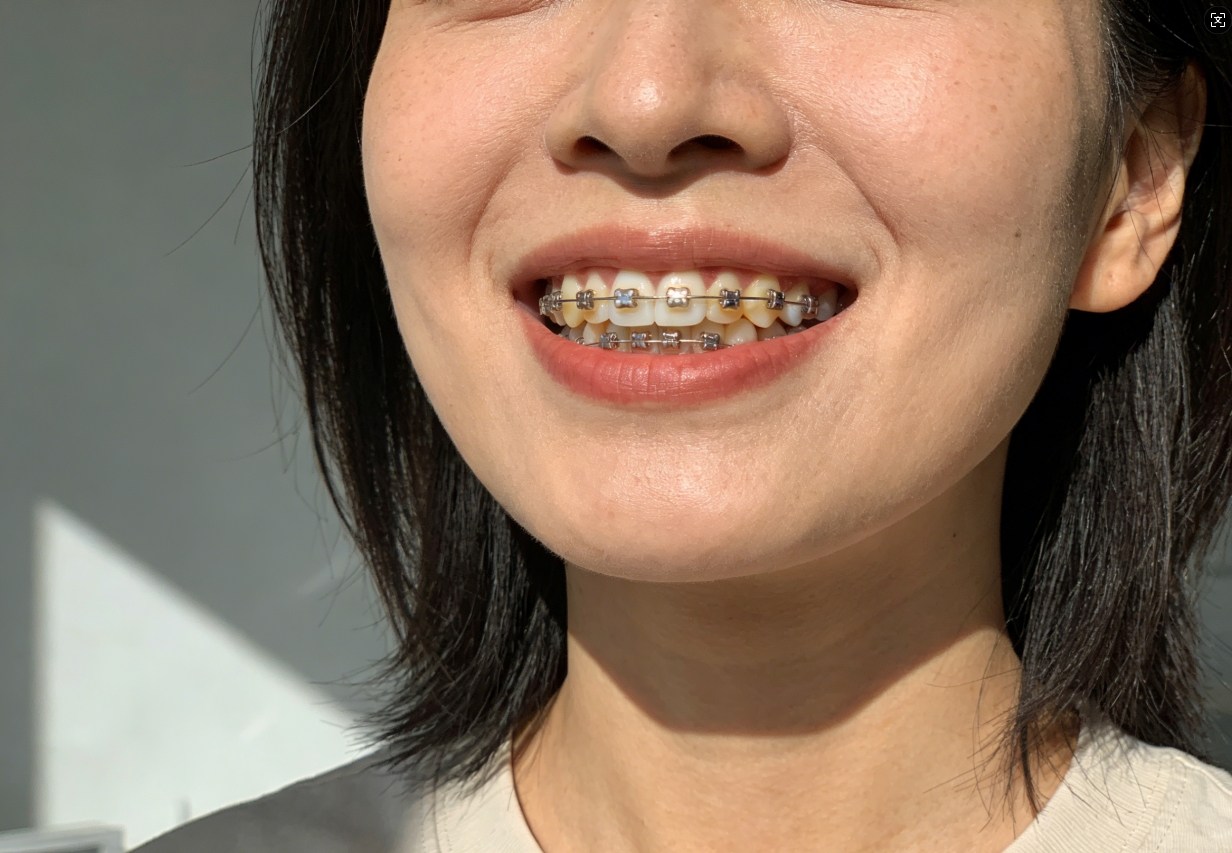 半口种牙选什么材料好？医生详解纯钛、全瓷优劣，帮你省心做决定