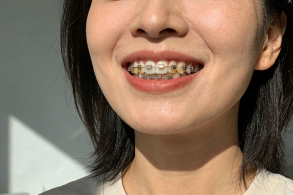 矫正牙齿需要多少钱？2026最新报价+省钱避坑指南