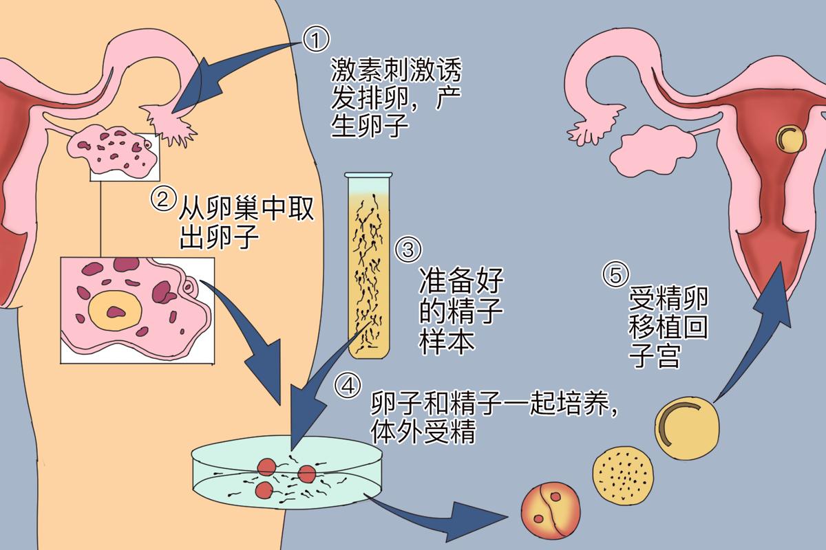 试管取卵一般取几个比较好_试管取卵_试管取卵疼吗