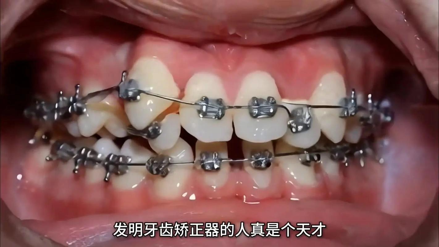 牙齿矫正能用医保报销吗_34岁能牙齿矫正吗_牙齿矫正能走医保吗
