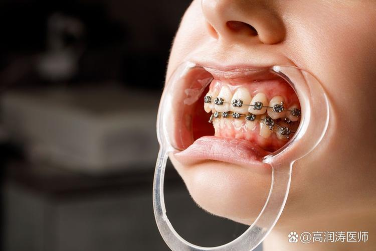 矫正牙齿成年可以做吗_成人牙齿矫正还能做磁共振吗_成人还能做牙齿矫正