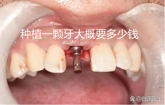 纯钛种牙多少钱一颗？费用明细和影响因素都在这里