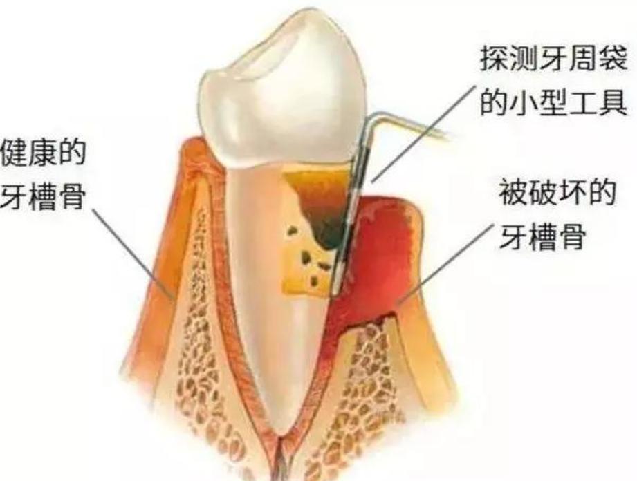 深圳牙槽骨太薄种牙有救吗？医生说实话