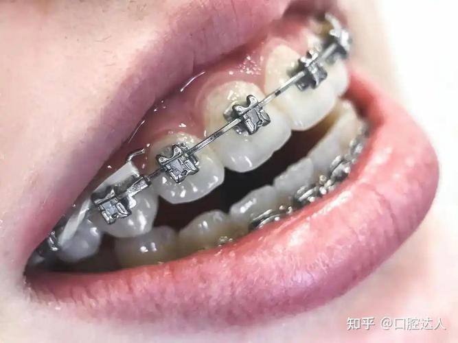 矫正牙齿到底要花多少钱