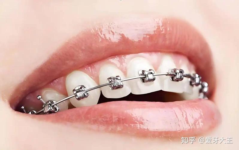 矫正牙齿要全款吗_牙齿矫正大概要花_把牙矫正需要几个钱