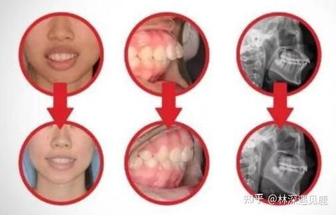 深圳隐适美矫正价格_深圳隐形矫正多少钱_深圳宝安隐适美矫正多少钱