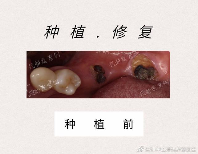 种牙前检查费用_牙术种植深圳检查做前景怎么样_深圳种植牙术前需要做哪些检查