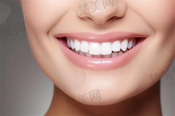 杭州自锁牙齿矫正多少钱？真实费用全揭秘