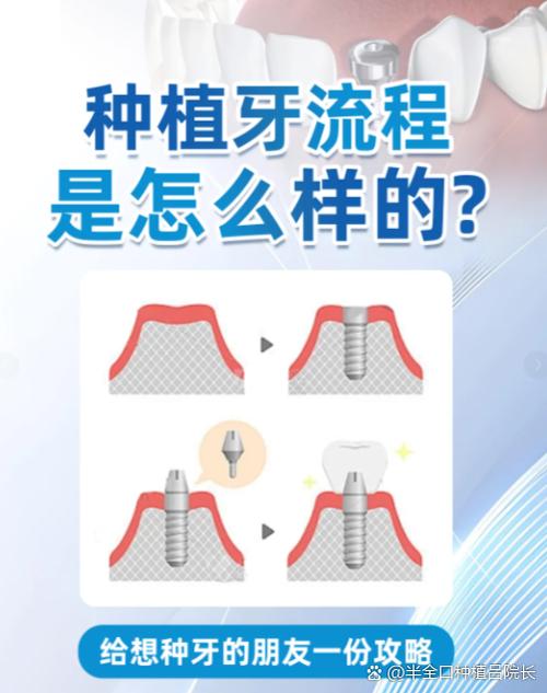 种上门牙多少钱一颗啊_上门牙种植风险大吗_上门牙种牙