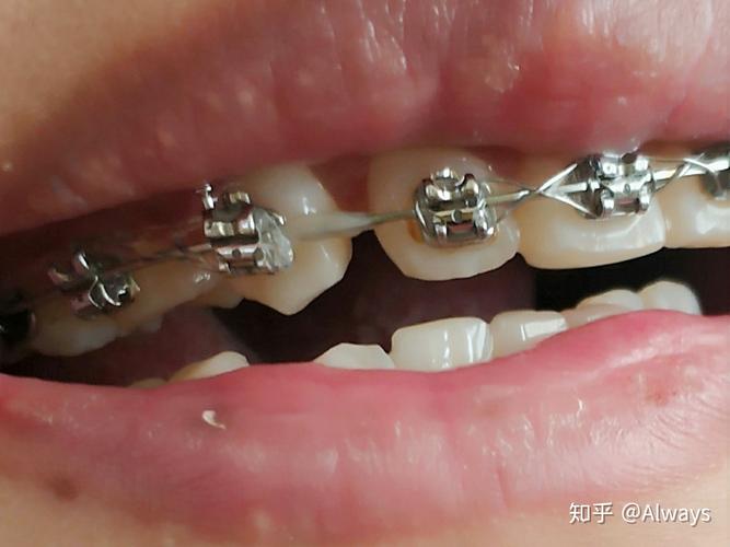 牙齿矫正还能戴牙冠嘛_22岁还能矫正牙齿_牙齿矫正还能当兵吗
