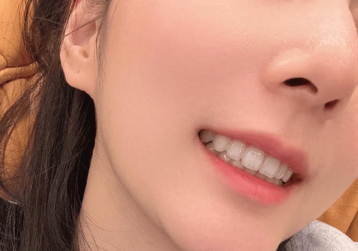 牙齿矫正可以只做上排牙吗_牙齿矫正可以分期付款吗_35岁牙齿还可以矫正吗
