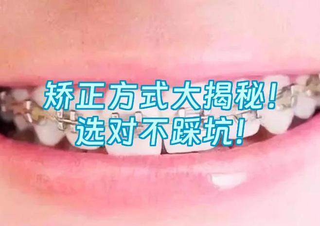 深圳宝安金属自锁托槽矫正医院_深圳宝安区矫正牙齿_深圳金属矫正牙价格是多少钱
