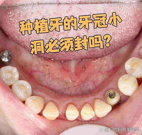 深圳龙华全口种牙当天戴牙冠靠谱吗