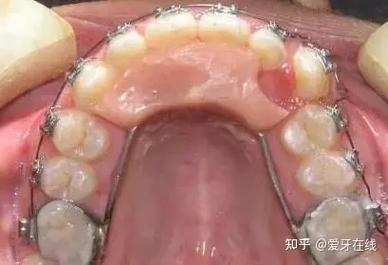深圳深覆合正畸牙科推荐_深覆合整牙价格_深覆牙合矫正