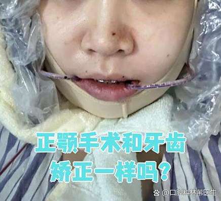 牙齿矫正颌垫_矫正牙齿正颌_牙齿矫正颌导板的作用