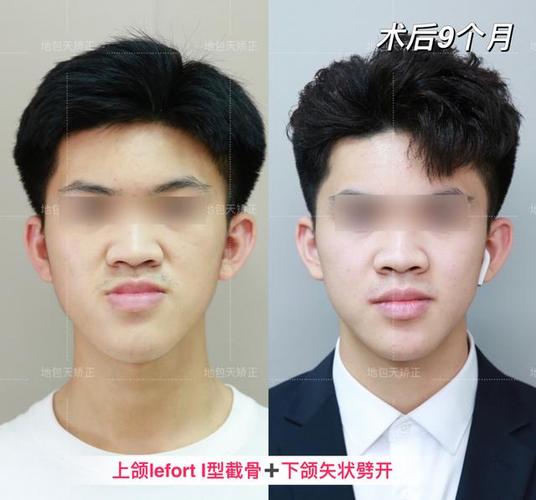 矫正牙齿正颌_牙齿矫正颌垫_牙齿矫正颌导板的作用