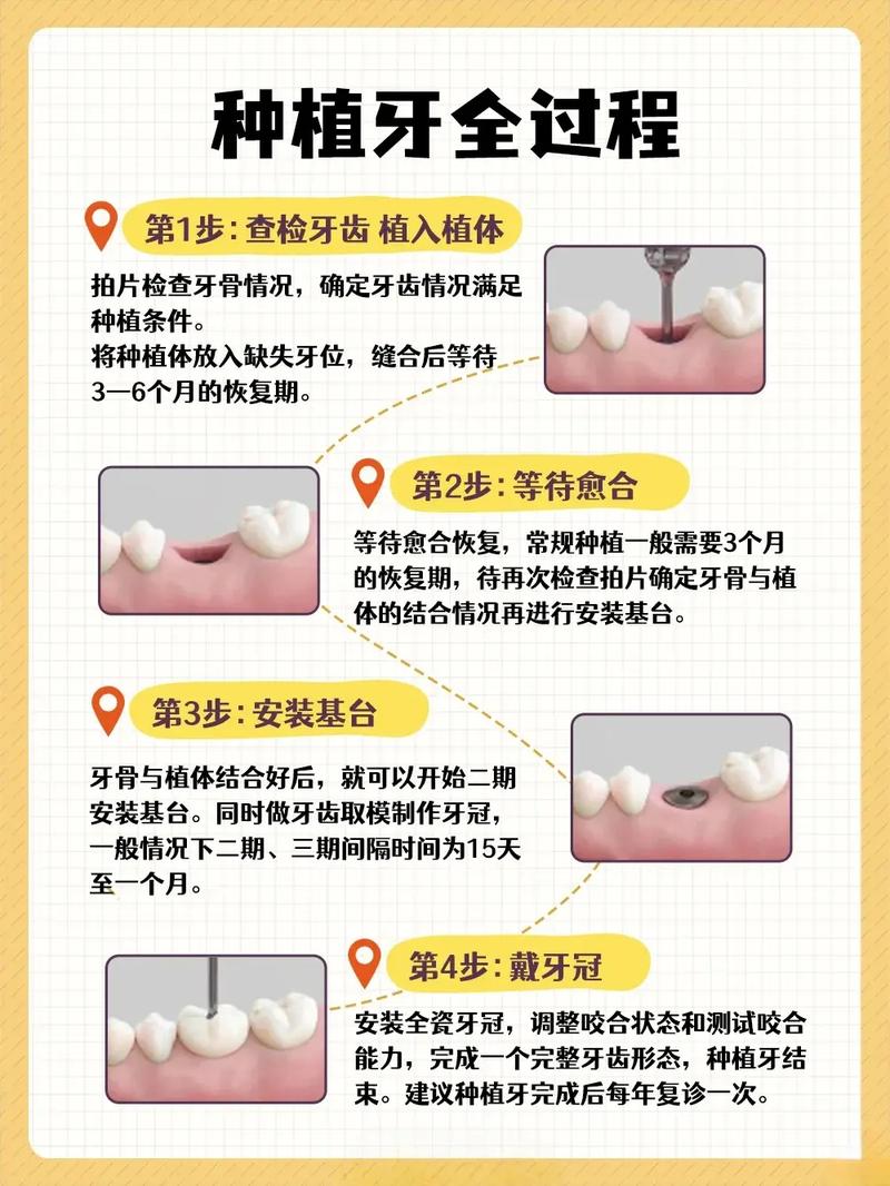 口腔种植牙手术_登特口腔植牙_植牙手术