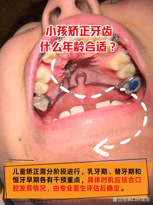 宝宝地包天矫正需要多长时间_宝宝地包天牙齿怎么纠正_宝宝地包天矫正
