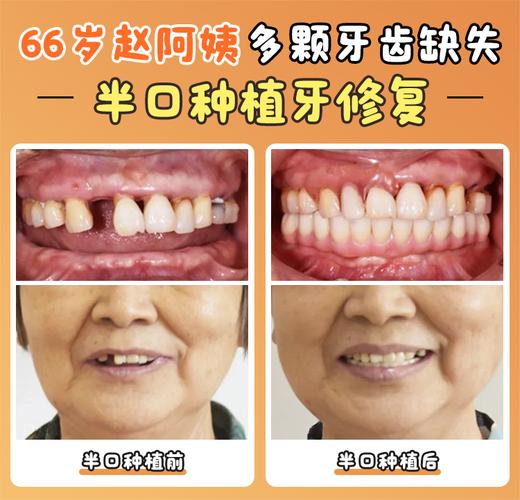 成年矫正牙齿价格_牙齿矫正成都_成都成年人牙齿矫正一般多少钱
