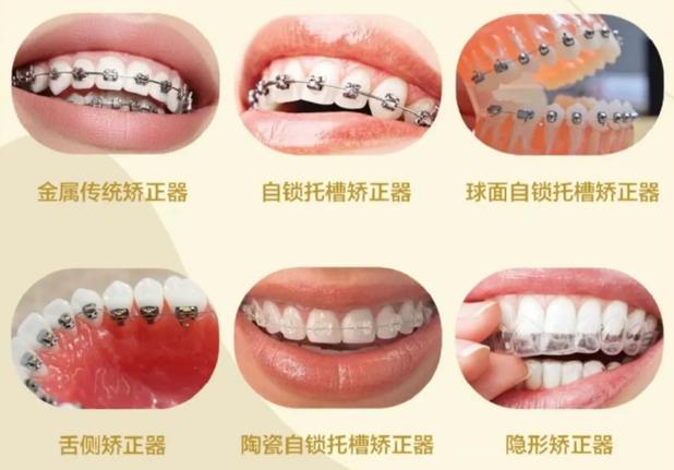 牙齿矫正成都_成年矫正牙齿价格_成都成年人牙齿矫正一般多少钱