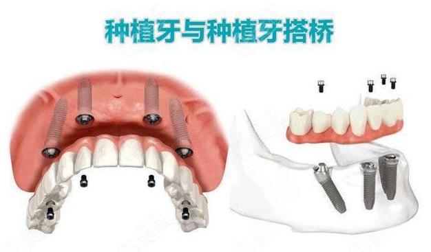 种植牙还是搭桥哪个更好