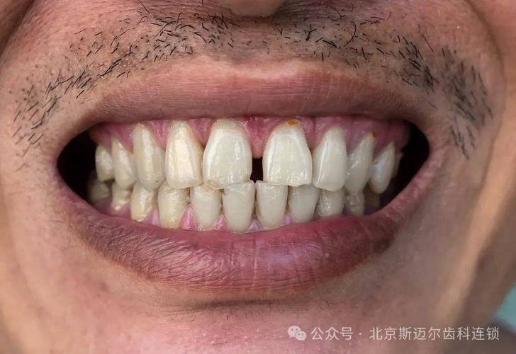 成人牙齿矫正收缝要多久_牙齿矫正大概要花费多少钱深圳_深圳成年人牙缝大矫正方案