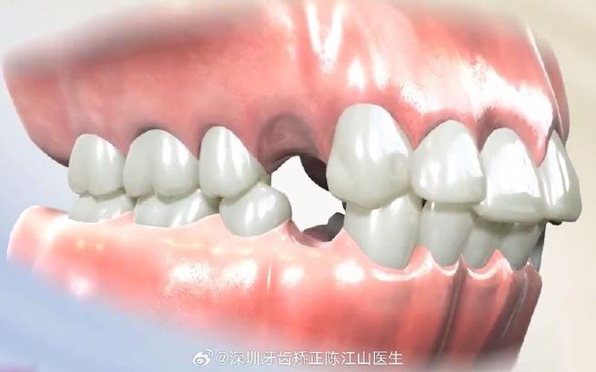 深圳成年人牙缝大矫正方案_成人牙齿矫正收缝要多久_牙齿矫正大概要花费多少钱深圳