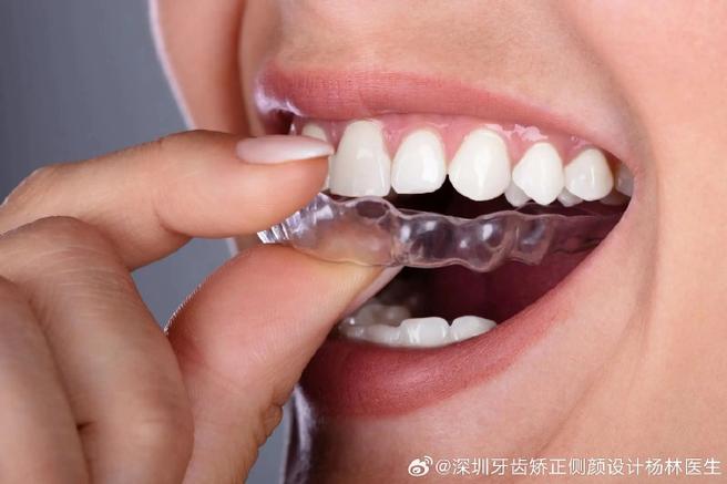 深圳龙岗隐适美矫正周期多久_深圳隐形矫正多少钱_深圳隐适美大概多少钱