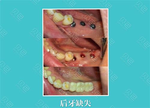 龙岗中心城种植牙医院怎么选 本地人的真实推荐