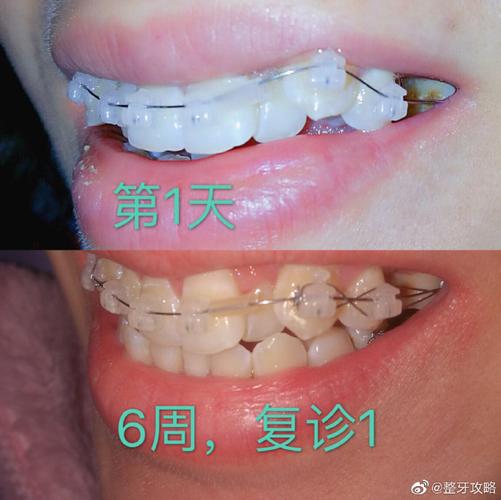 深圳牙缝过大矫正多少钱 价格表一览