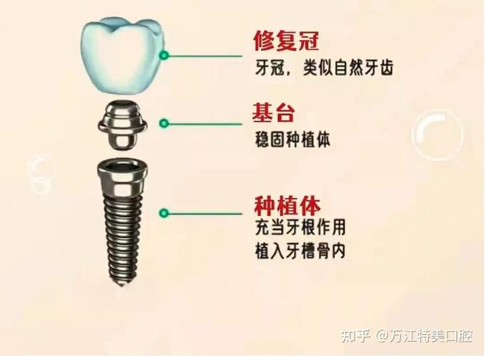 东莞种植牙价格_东莞种植牙收费标准_东莞种植牙5000元能做吗