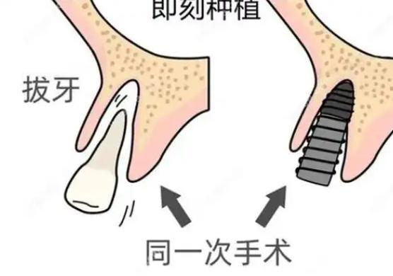 种植牙即拔即种适应症_种植牙即拔即种条件_即拔即种植牙