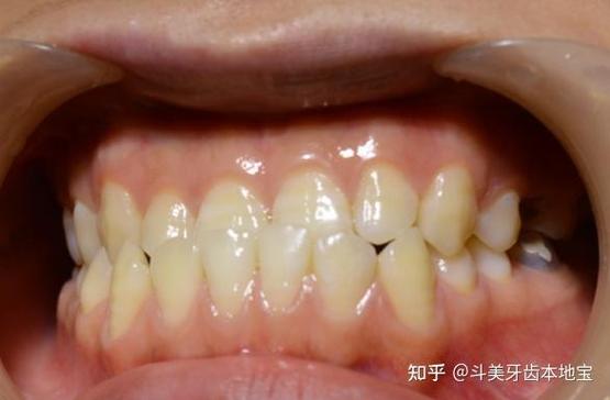 深圳龙华钢丝矫正靠谱牙科_深圳钢牙矫正_深圳龙华牙齿矫正