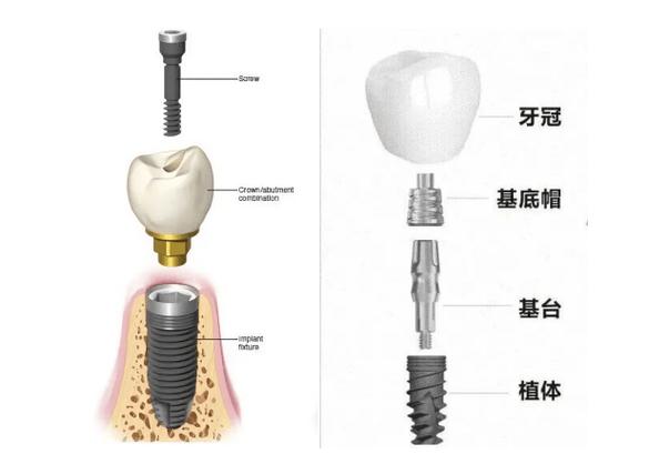 种牙全过程要多久？看完心里有数