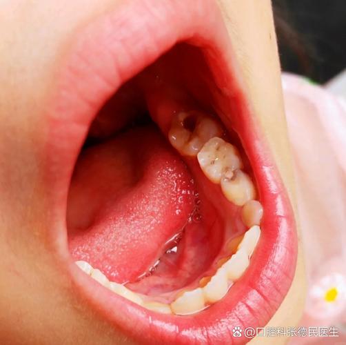 原因牙齿酸痛宝宝吃什么好_原因牙齿酸痛宝宝怎么办_宝宝牙齿酸痛什么原因