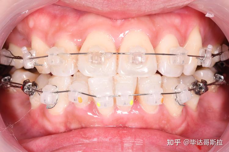 成人牙齿矫正深圳多少钱_成人牙齿矫正深圳哪家好_深圳成人牙齿矫正