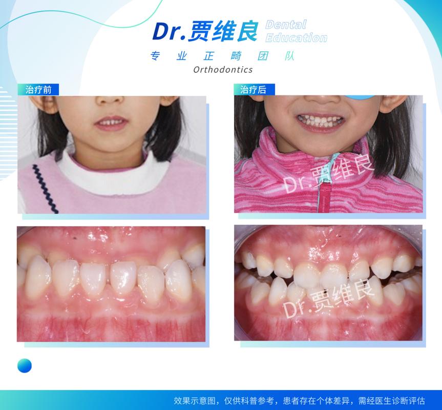 儿童牙齿校正几岁开始做合适?