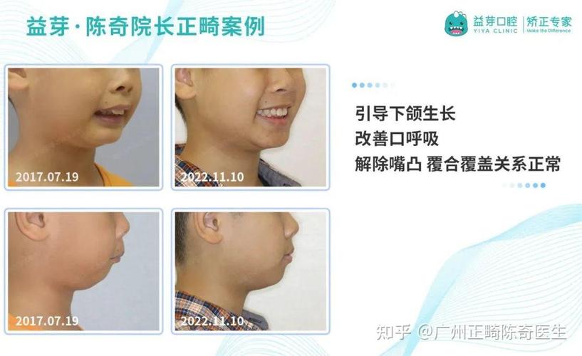 儿童矫正东莞哪里好_东莞孩子矫正牙齿哪家好_东莞儿童牙齿矫正